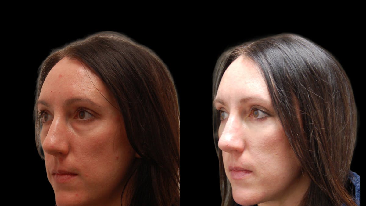 Lower Eyelid Surgery Before & After Gallery - Patient 393443 - Image 1