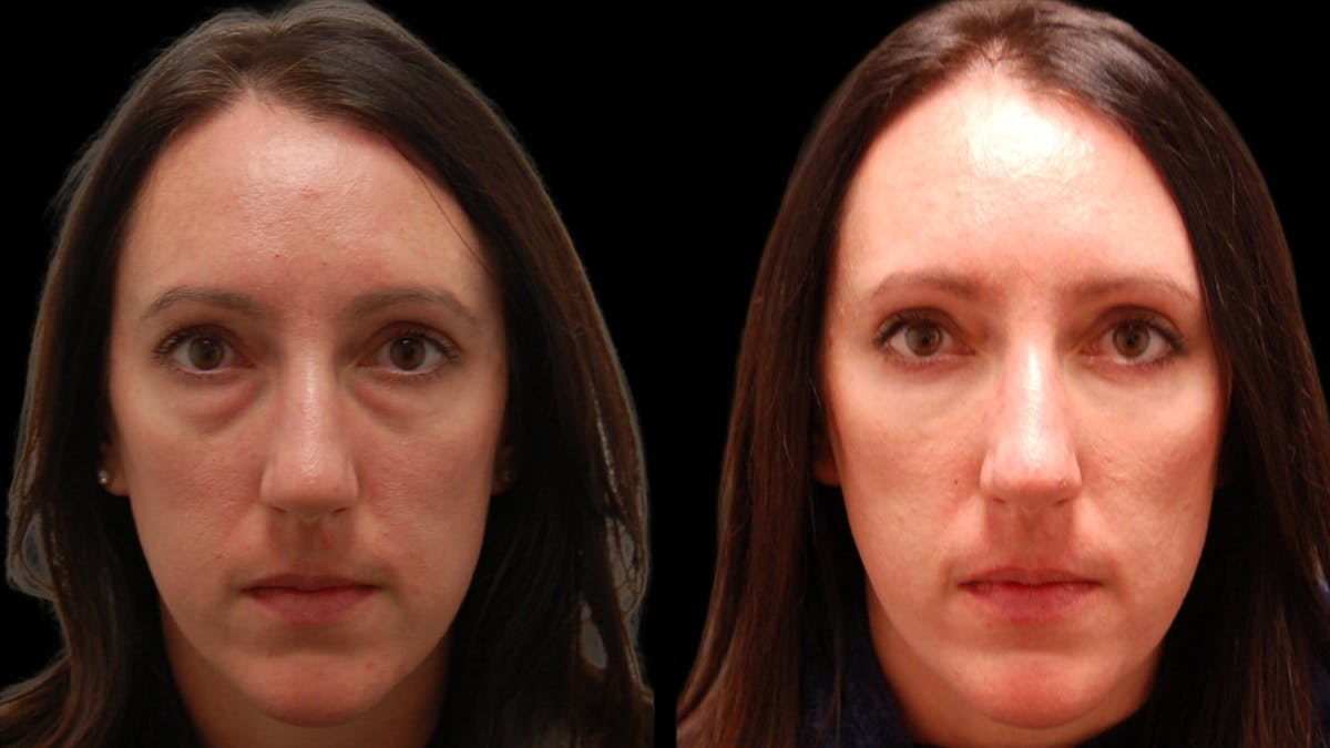 Lower Eyelid Surgery Before & After Gallery - Patient 393443 - Image 2