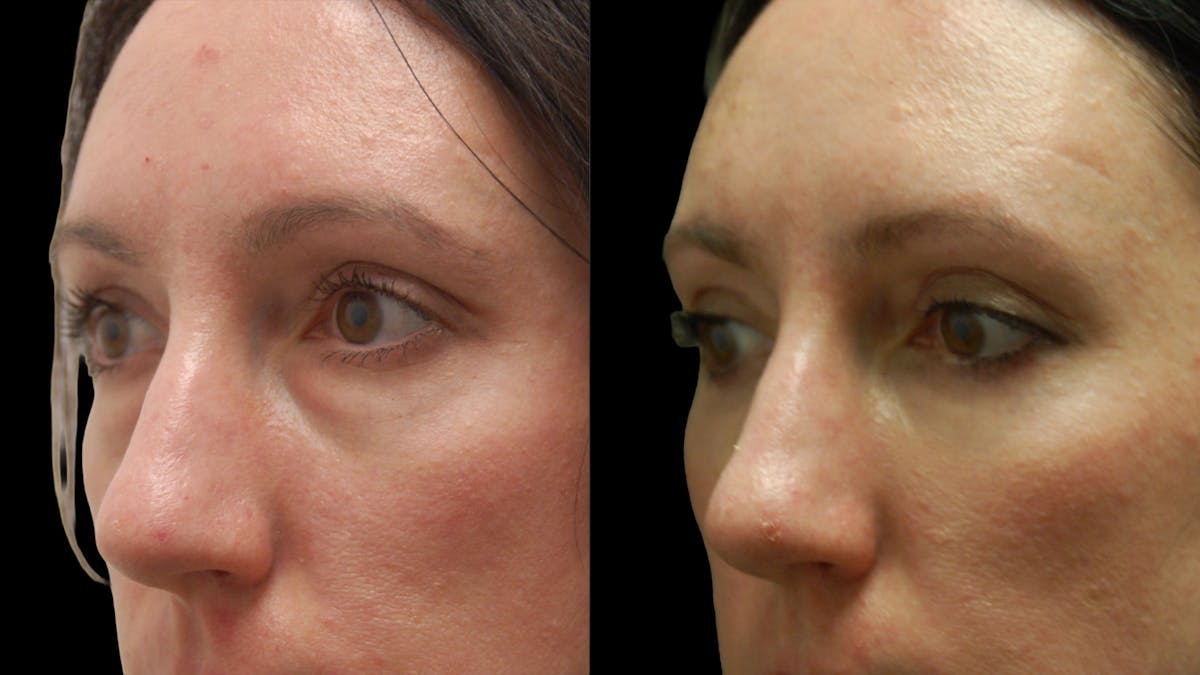 Lower Eyelid Surgery Before & After Gallery - Patient 393443 - Image 6