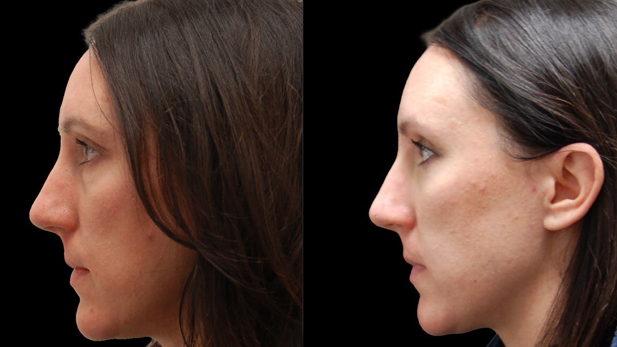 Lower Eyelid Surgery Before & After Gallery - Patient 393443 - Image 5