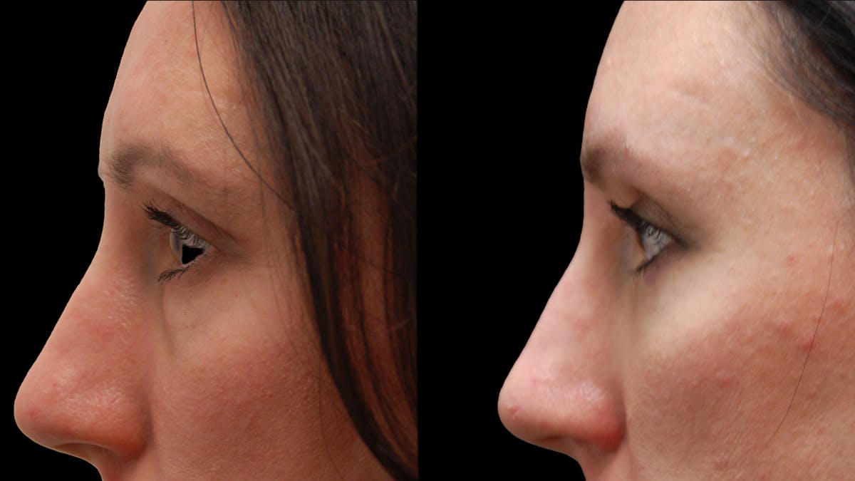 Lower Eyelid Surgery Before & After Gallery - Patient 393443 - Image 7