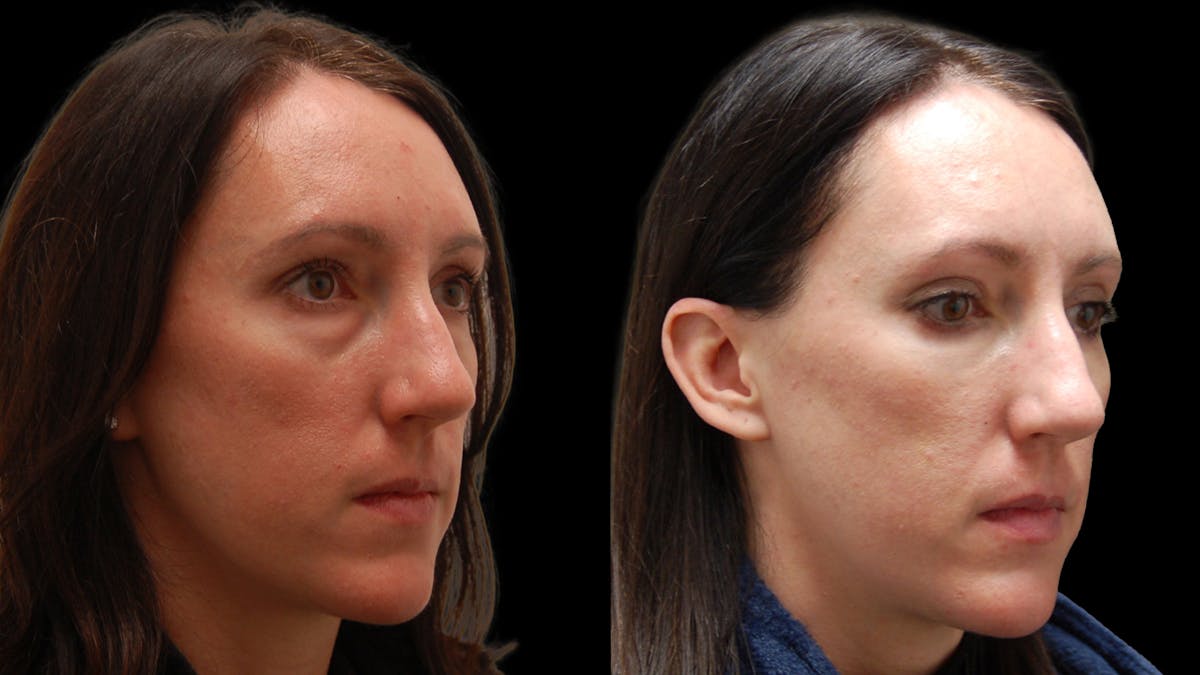 Lower Eyelid Surgery Before & After Gallery - Patient 393443 - Image 3