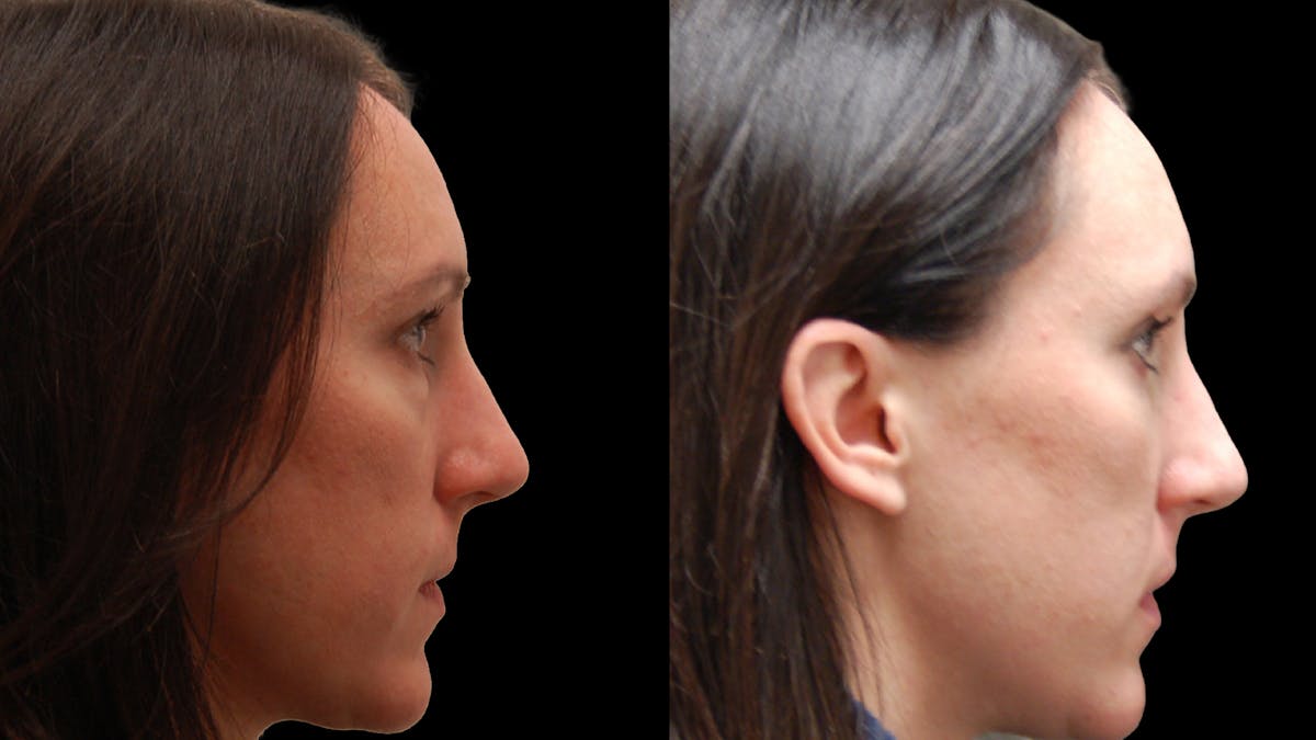 Lower Eyelid Surgery Before & After Gallery - Patient 393443 - Image 4