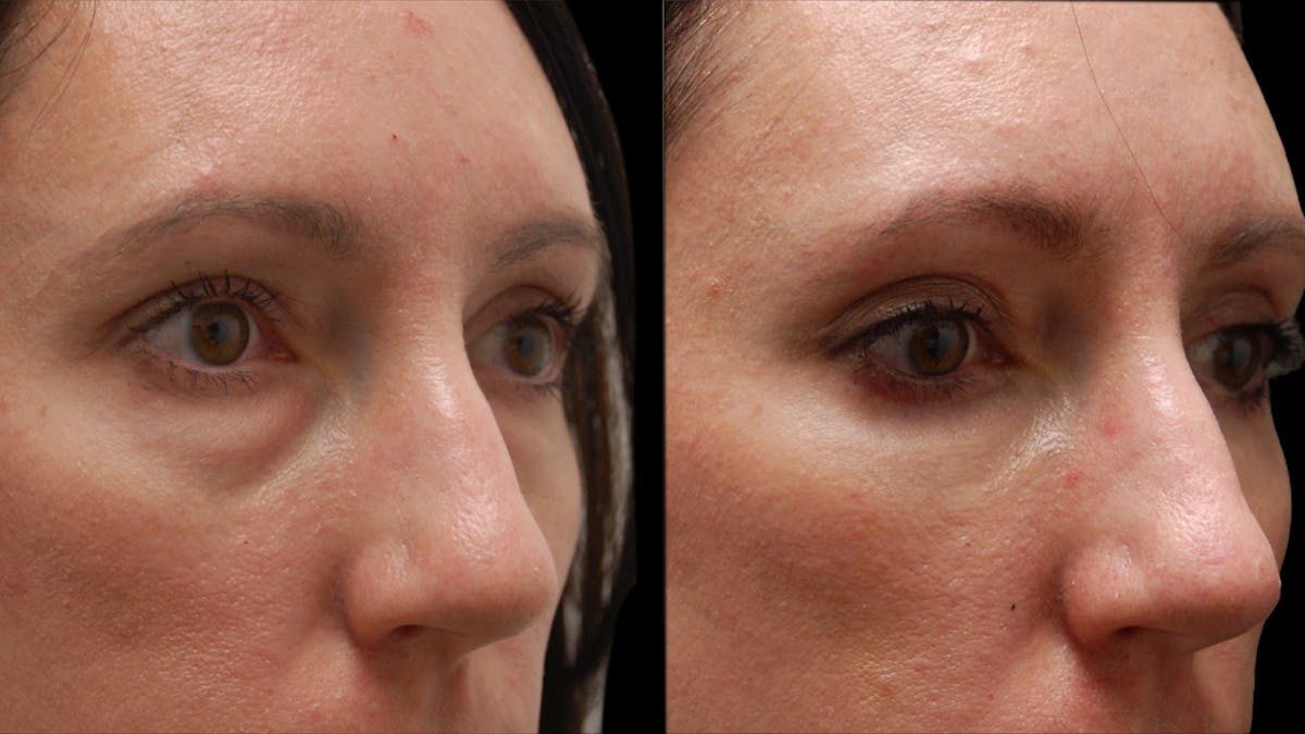 Lower Eyelid Surgery Before & After Gallery - Patient 393443 - Image 8