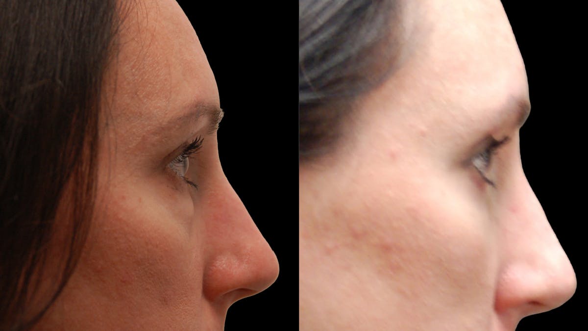 Lower Eyelid Surgery Before & After Gallery - Patient 393443 - Image 9
