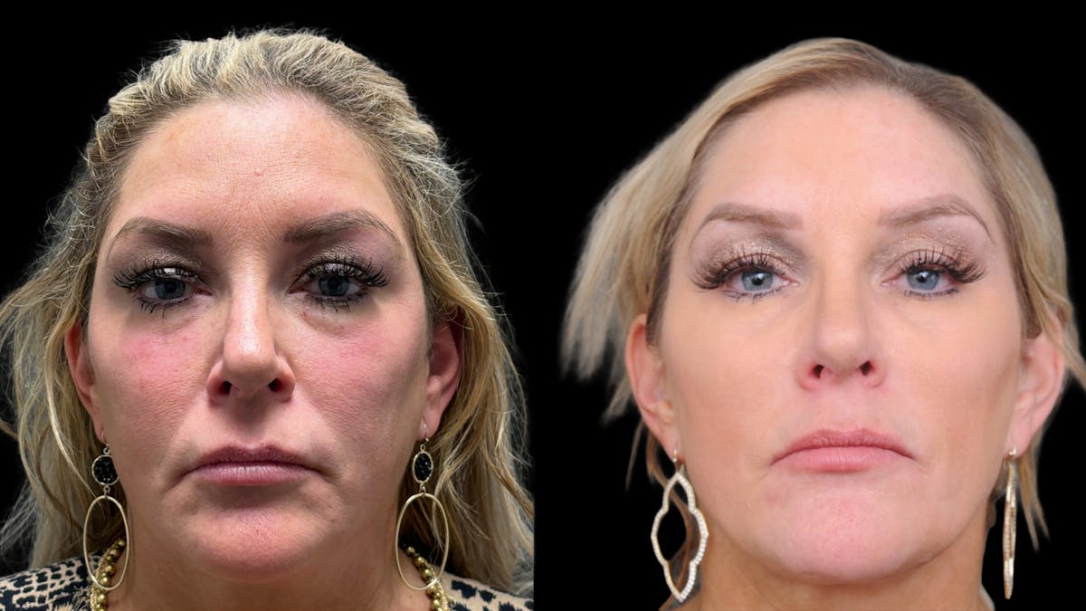 Lower Eyelid Surgery Before & After Gallery - Patient 326853 - Image 2
