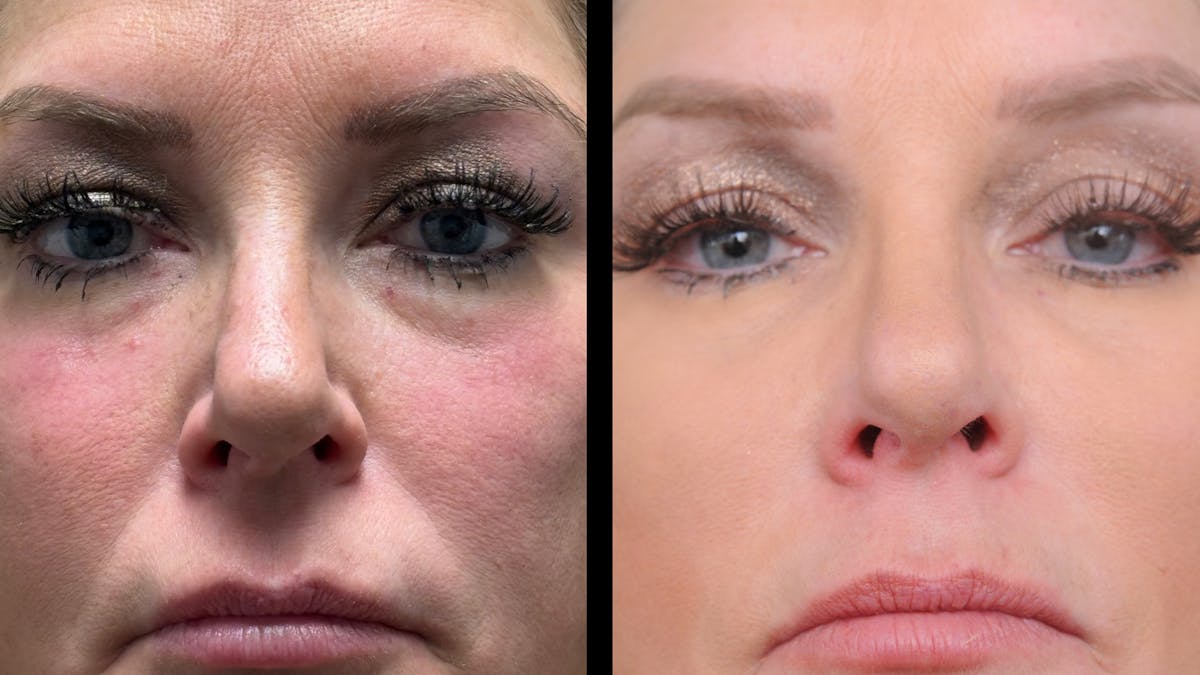 Lower Eyelid Surgery Before & After Gallery - Patient 326853 - Image 5