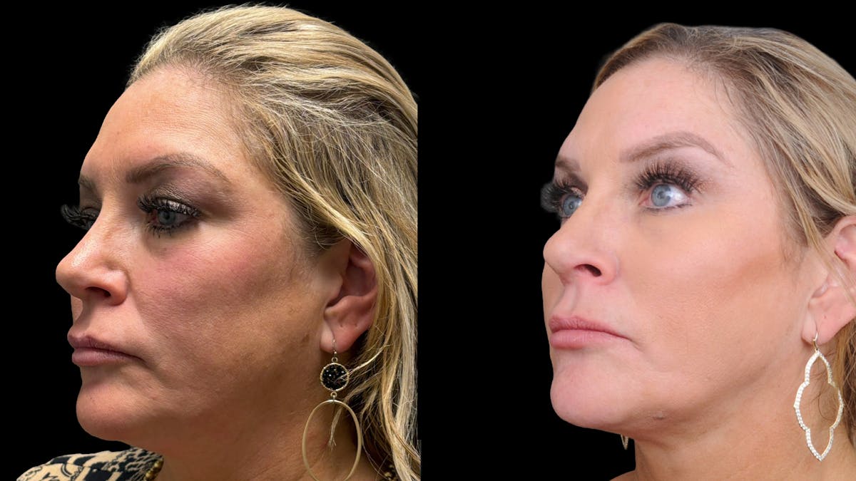 Lower Eyelid Surgery Before & After Gallery - Patient 326853 - Image 1