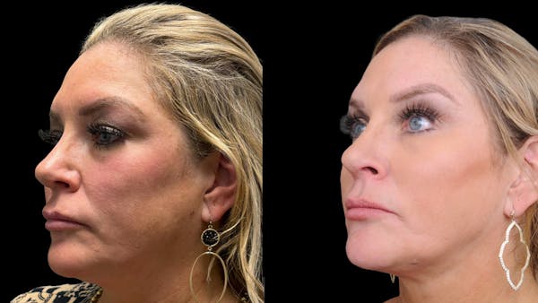 Lower Eyelid Surgery Before & After Gallery - Patient 326853 - Image 1