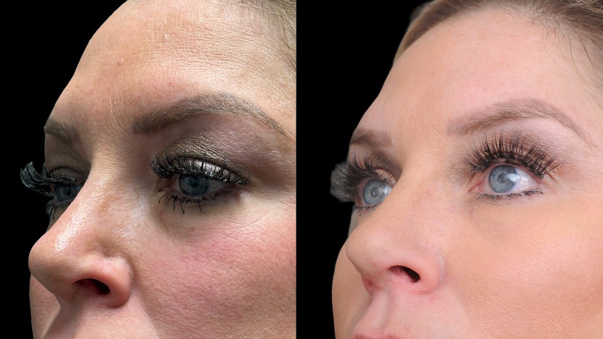 Lower Eyelid Surgery Before & After Gallery - Patient 326853 - Image 6