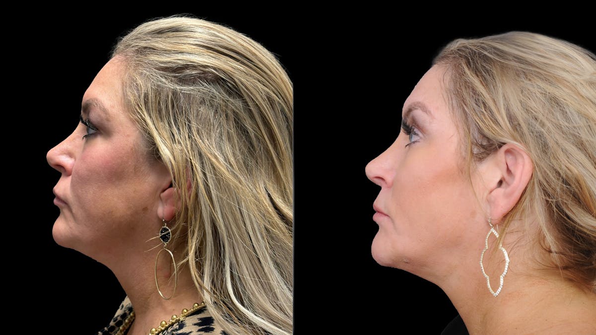 Lower Eyelid Surgery Before & After Gallery - Patient 326853 - Image 3