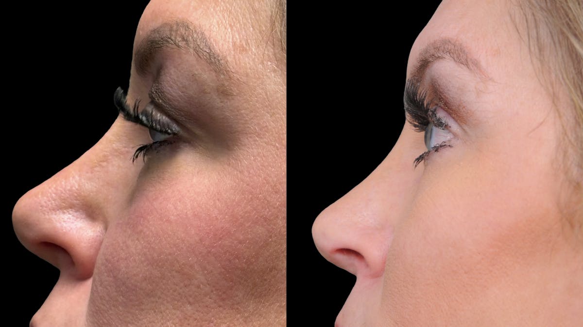 Lower Eyelid Surgery Before & After Gallery - Patient 326853 - Image 7