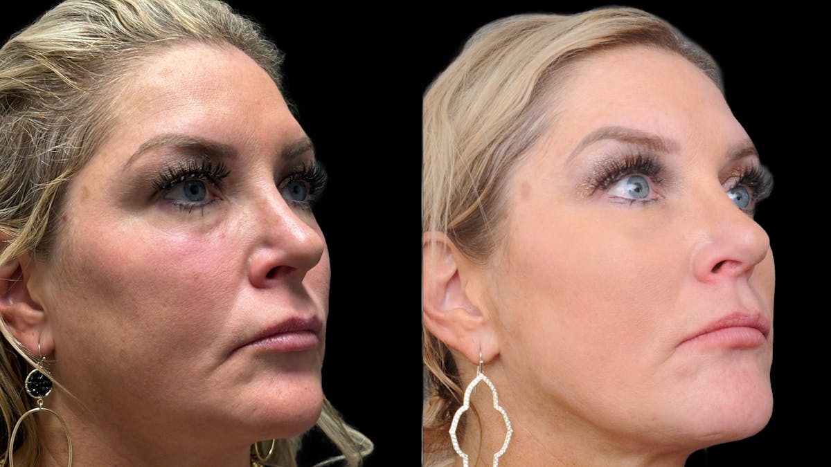 Lower Eyelid Surgery Before & After Gallery - Patient 326853 - Image 4