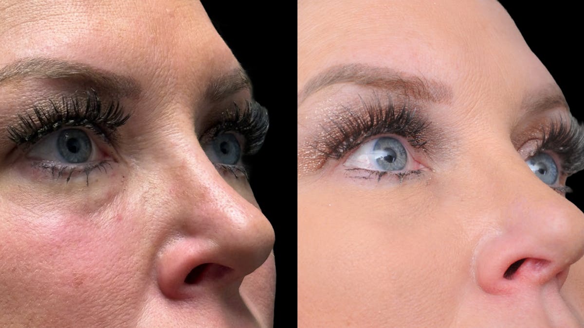 Lower Eyelid Surgery Before & After Gallery - Patient 326853 - Image 8