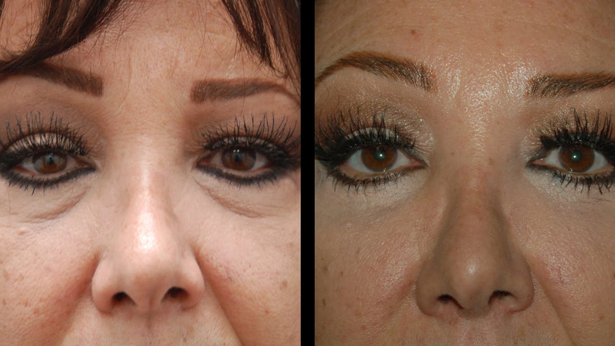 Lower Eyelid Surgery Before & After Gallery - Patient 245219 - Image 6