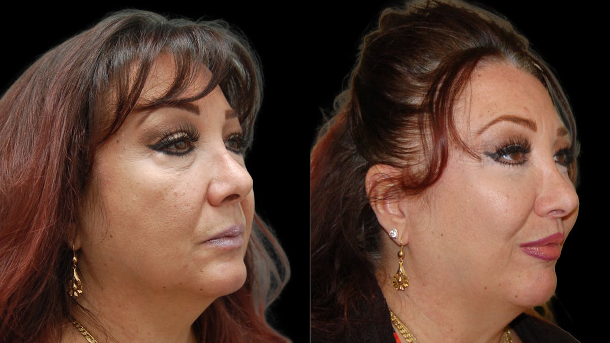 Lower Eyelid Surgery Before & After Gallery - Patient 245219 - Image 4
