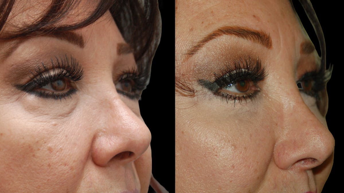 Lower Eyelid Surgery Before & After Gallery - Patient 245219 - Image 7