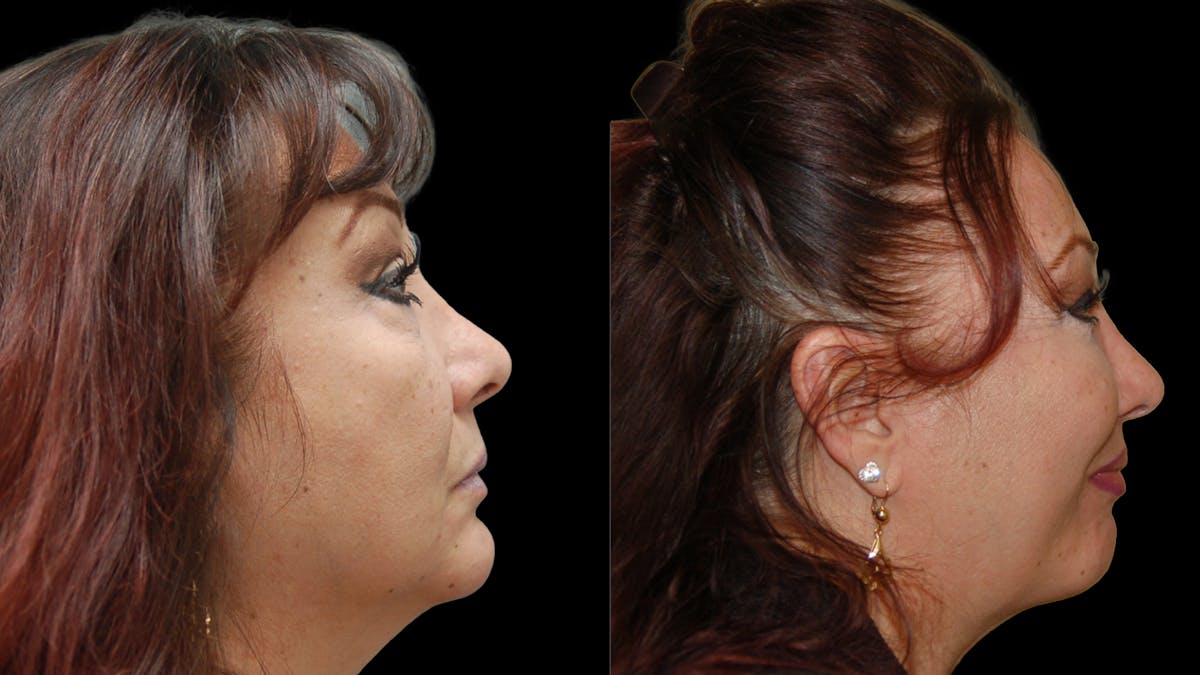 Lower Eyelid Surgery Before & After Gallery - Patient 245219 - Image 3
