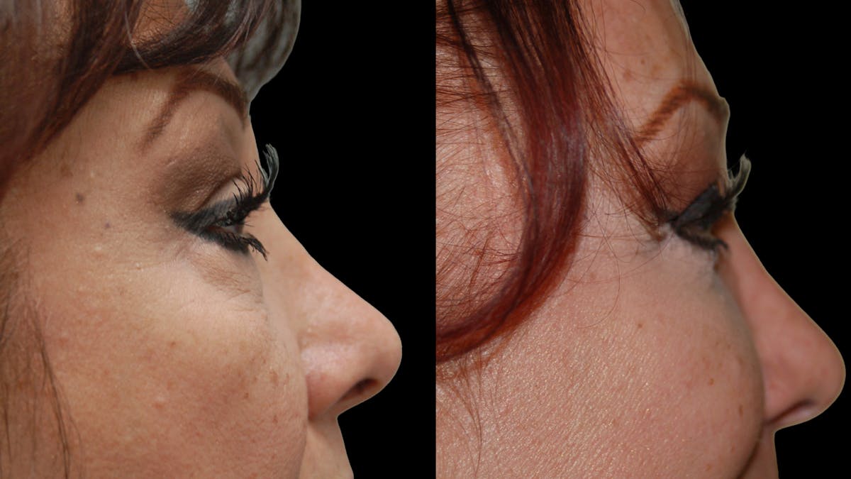 Lower Eyelid Surgery Before & After Gallery - Patient 245219 - Image 8