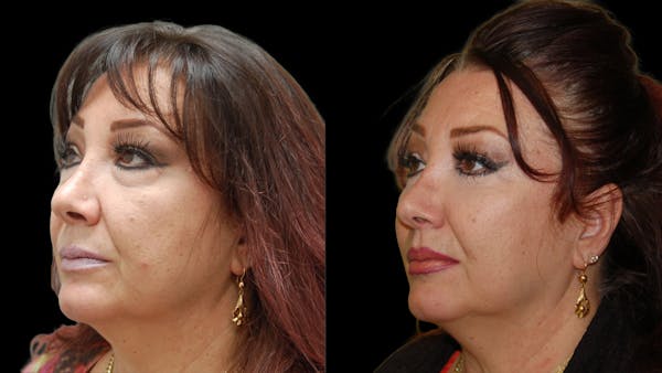 Lower Eyelid Surgery Before & After Gallery - Patient 245219 - Image 1