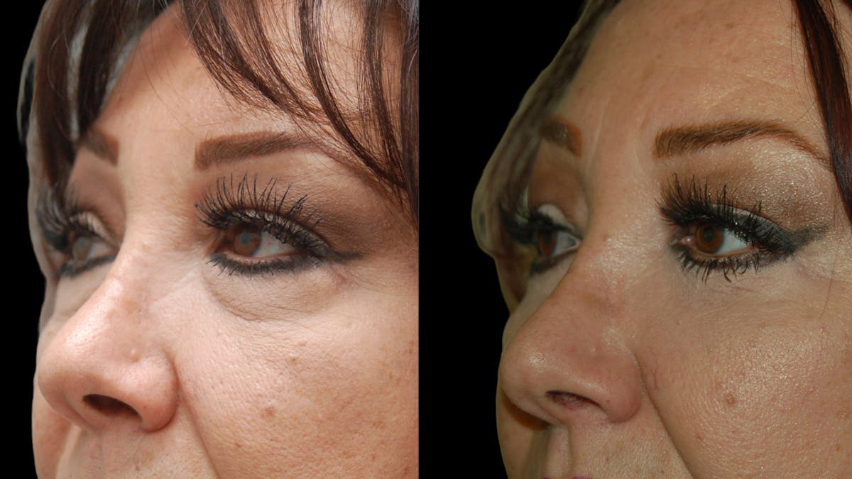 Lower Eyelid Surgery Before & After Gallery - Patient 245219 - Image 9