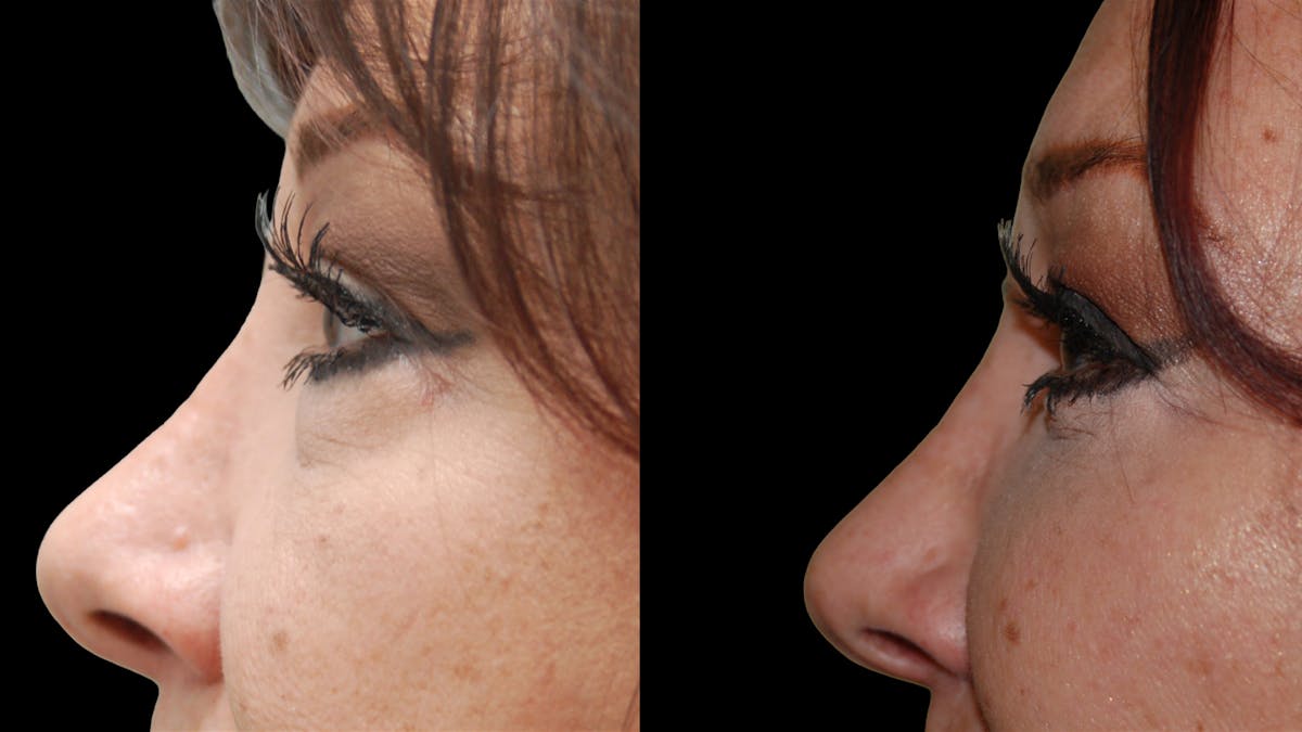 Lower Eyelid Surgery Before & After Gallery - Patient 245219 - Image 10