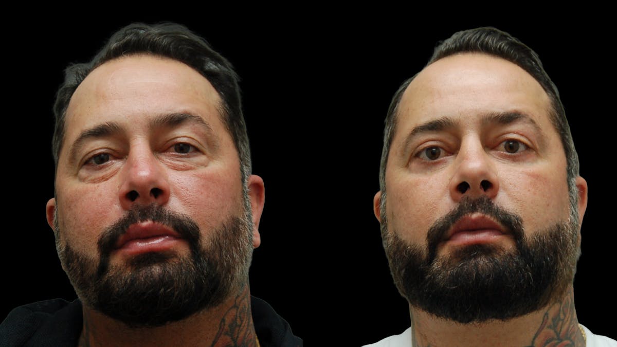 Lower Eyelid Surgery Before & After Gallery - Patient 338537 - Image 5