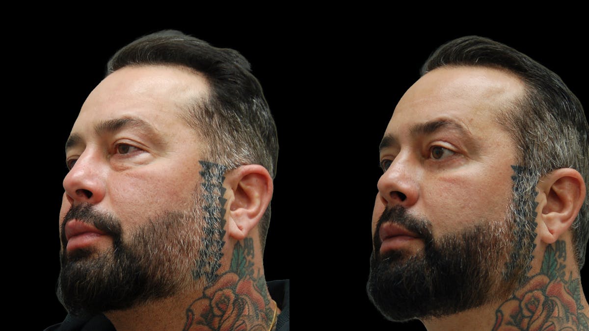 Lower Eyelid Surgery Before & After Gallery - Patient 338537 - Image 1