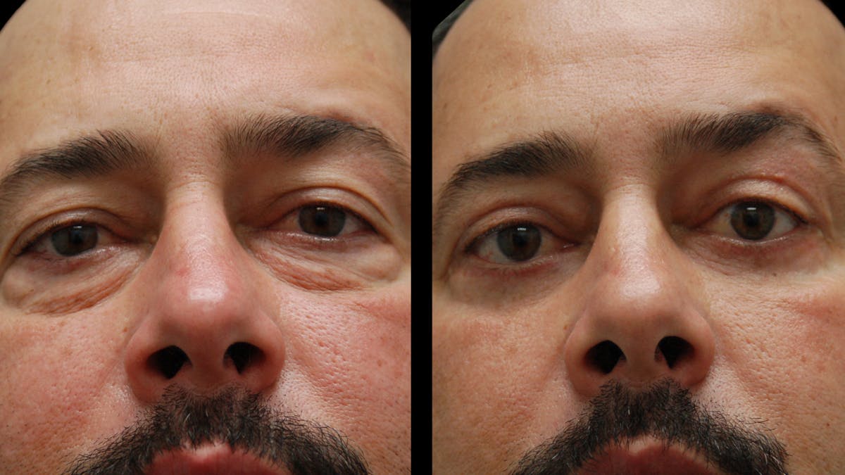 Lower Eyelid Surgery Before & After Gallery - Patient 338537 - Image 6