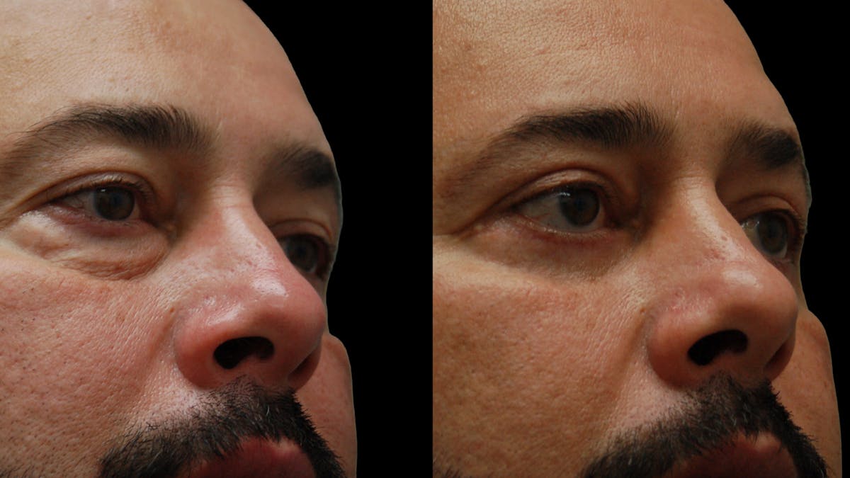 Lower Eyelid Surgery Before & After Gallery - Patient 338537 - Image 7