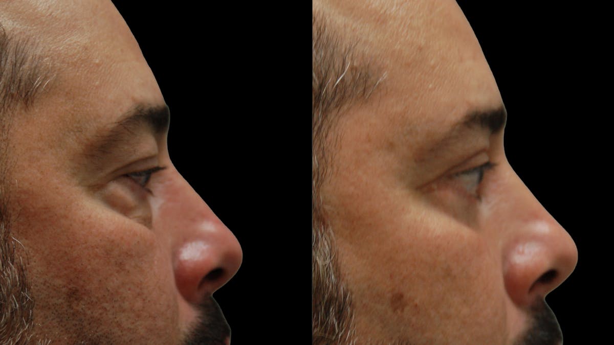 Lower Eyelid Surgery Before & After Gallery - Patient 338537 - Image 8