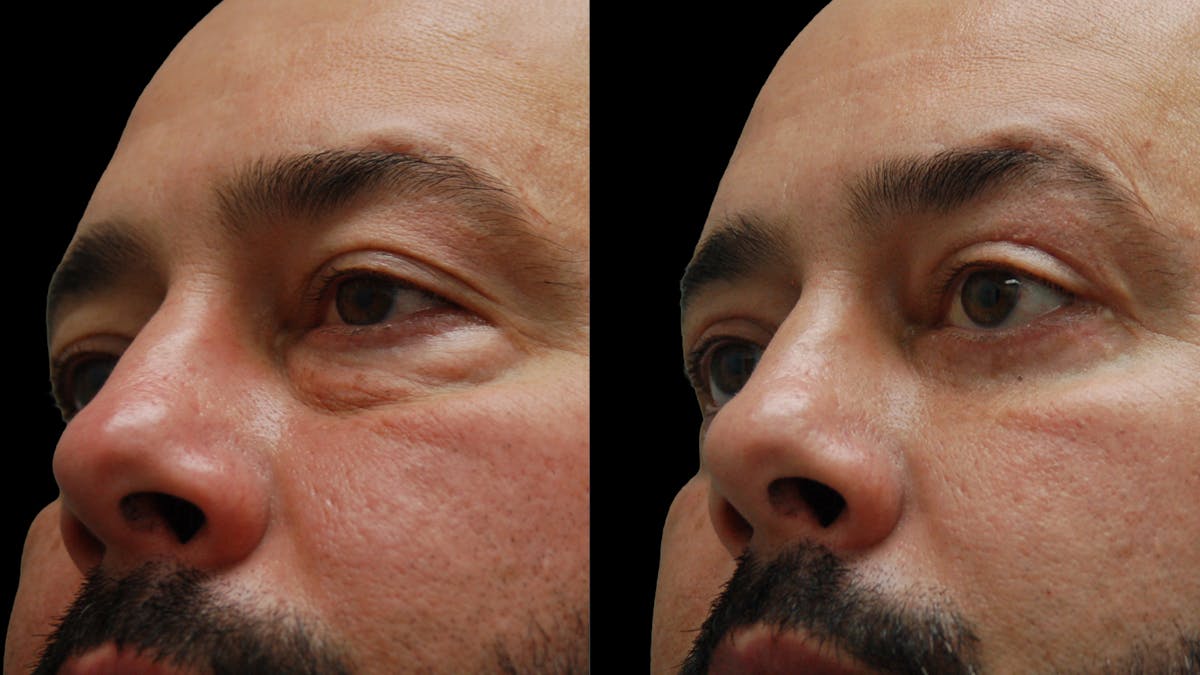 Lower Eyelid Surgery Before & After Gallery - Patient 338537 - Image 9