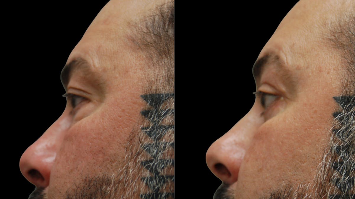 Lower Eyelid Surgery Before & After Gallery - Patient 338537 - Image 10