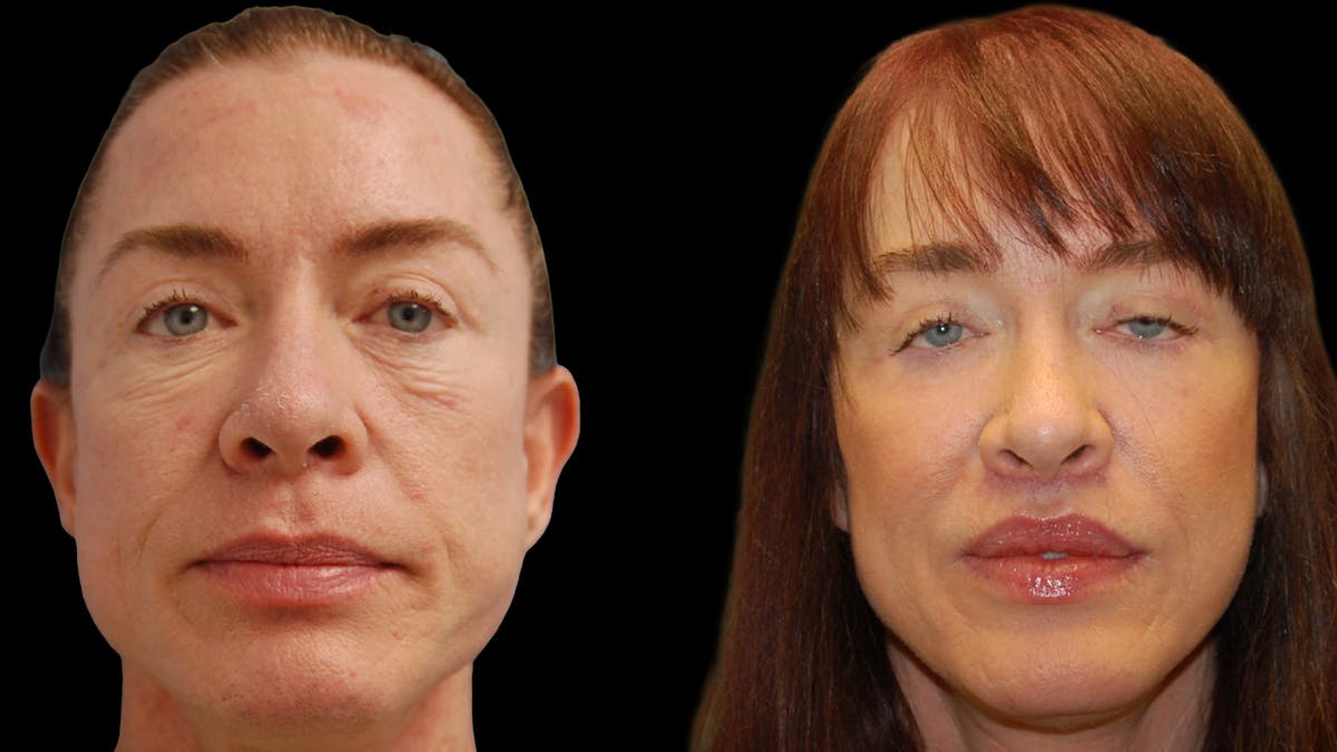 Lower Eyelid Surgery Before & After Gallery - Patient 205184 - Image 1