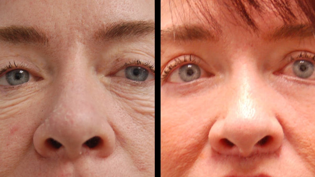 Lower Eyelid Surgery Before & After Gallery - Patient 205184 - Image 2