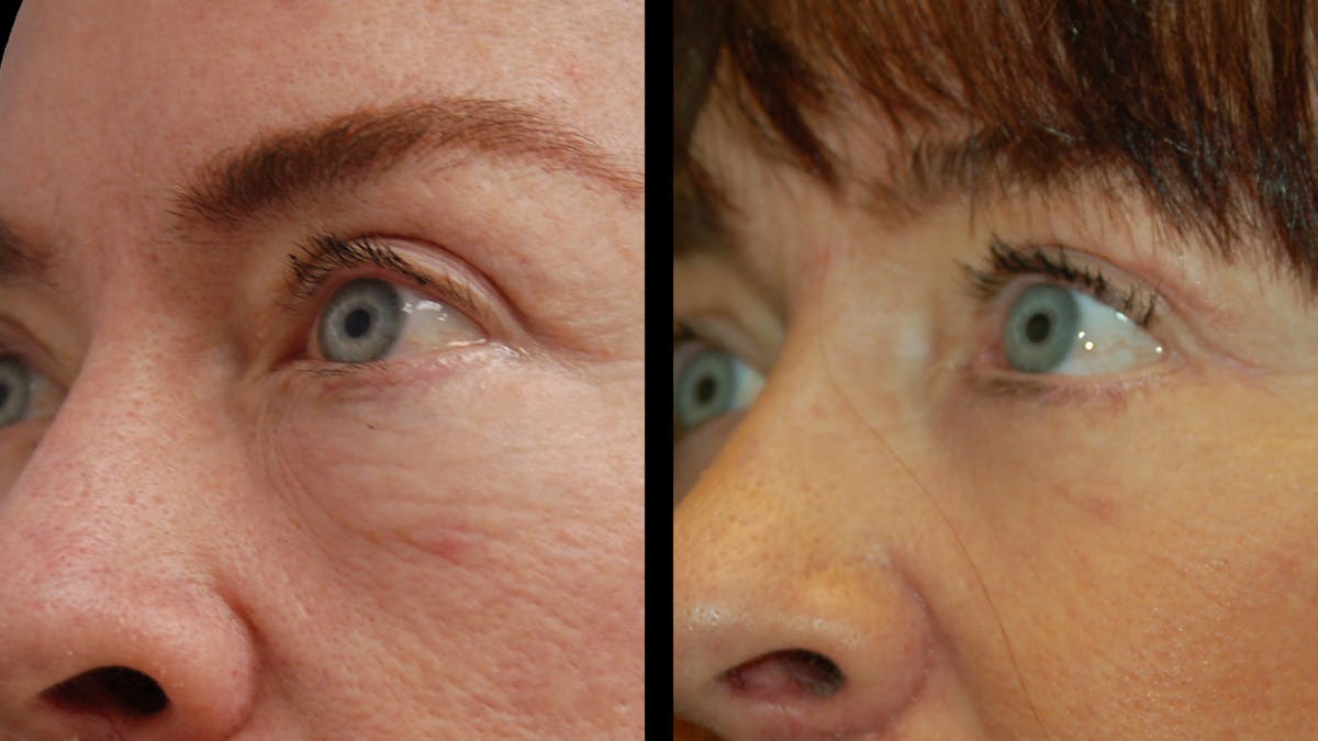 Lower Eyelid Surgery Before & After Gallery - Patient 205184 - Image 3