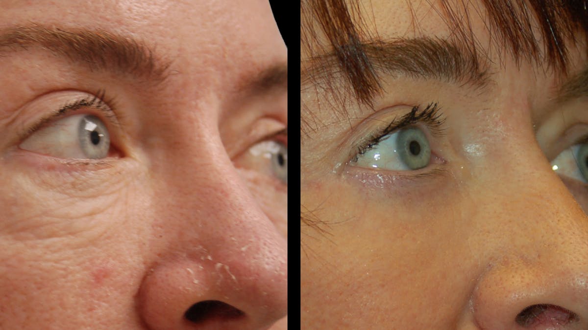 Lower Eyelid Surgery Before & After Gallery - Patient 205184 - Image 4