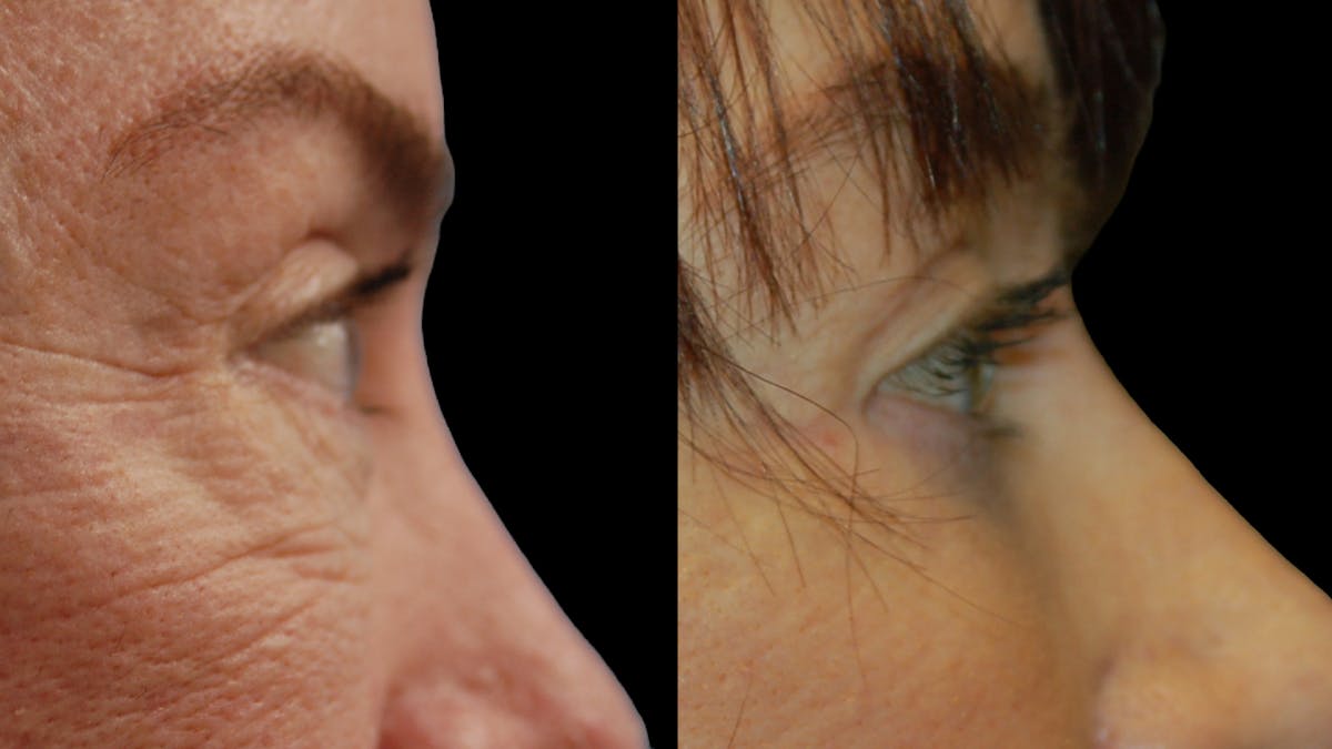 Lower Eyelid Surgery Before & After Gallery - Patient 205184 - Image 5