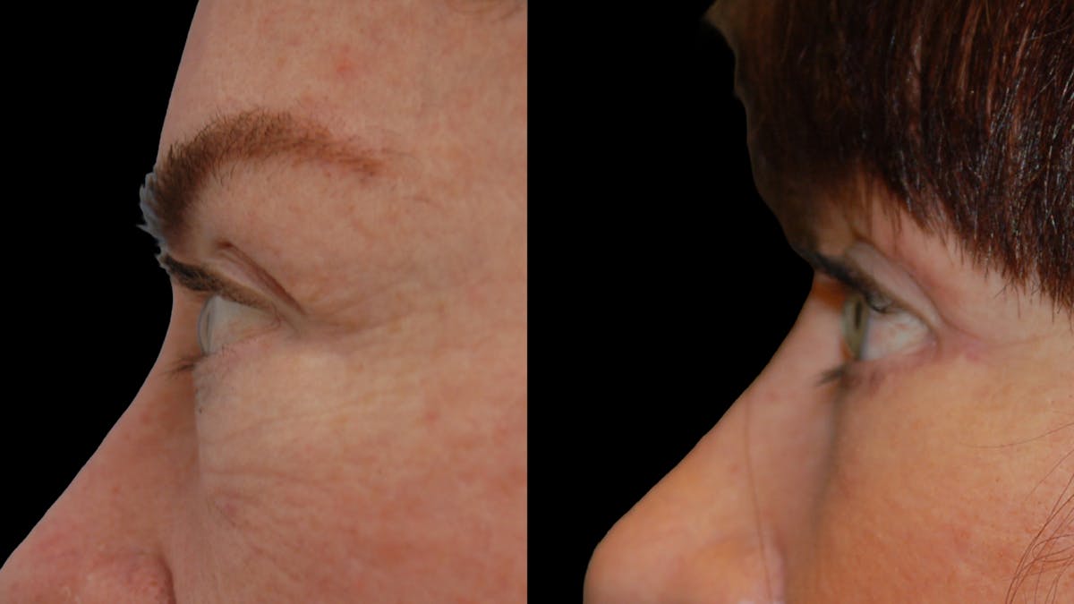 Lower Eyelid Surgery Before & After Gallery - Patient 205184 - Image 6