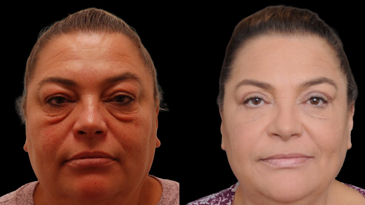 Lower Eyelid Surgery Before & After Gallery - Patient 272736 - Image 2