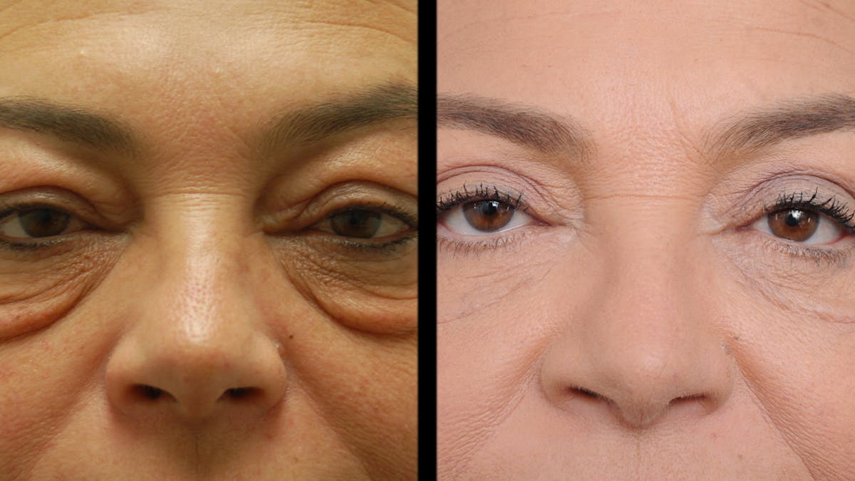 Lower Eyelid Surgery Before & After Gallery - Patient 272736 - Image 6