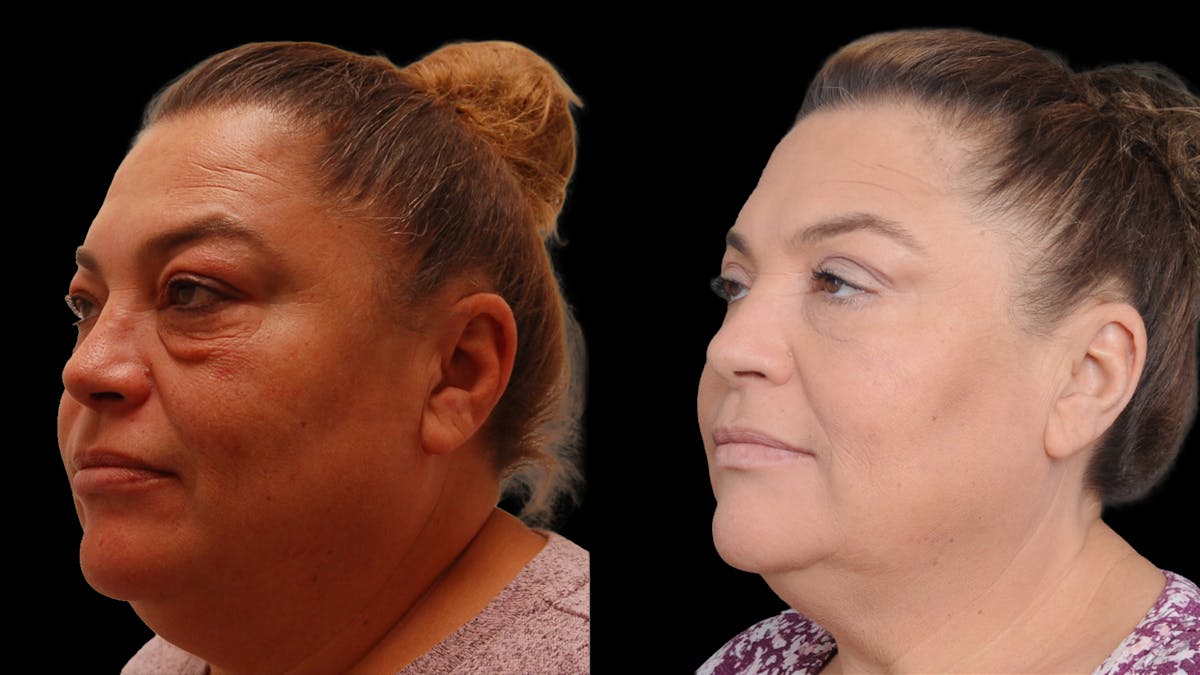 Lower Eyelid Surgery Before & After Gallery - Patient 272736 - Image 1