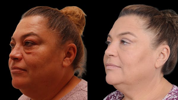 Lower Eyelid Surgery Before & After Gallery - Patient 272736 - Image 1