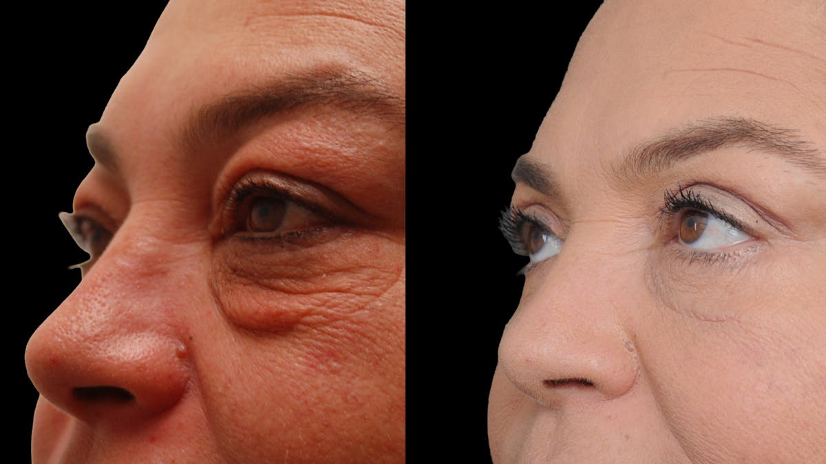 Lower Eyelid Surgery Before & After Gallery - Patient 272736 - Image 7