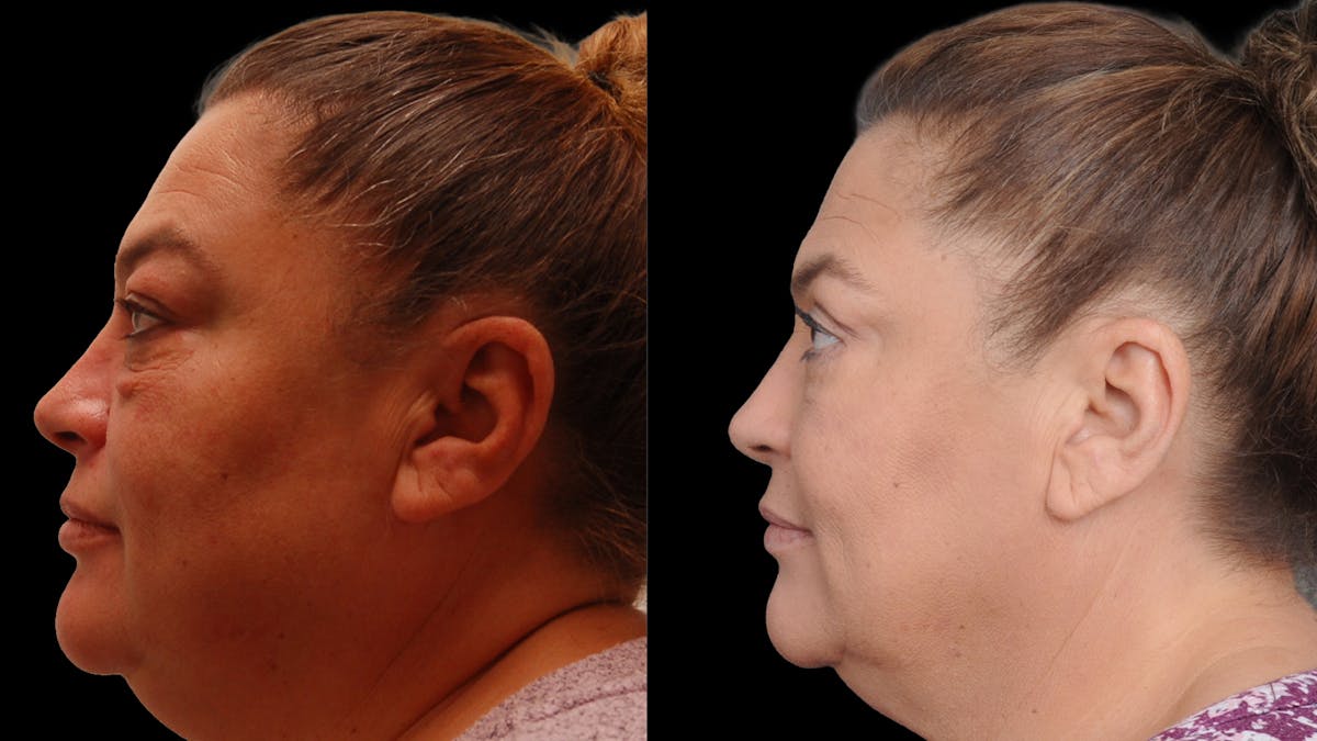Lower Eyelid Surgery Before & After Gallery - Patient 272736 - Image 3