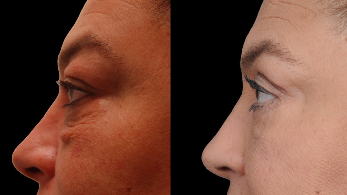 Lower Eyelid Surgery Before & After Gallery - Patient 272736 - Image 8