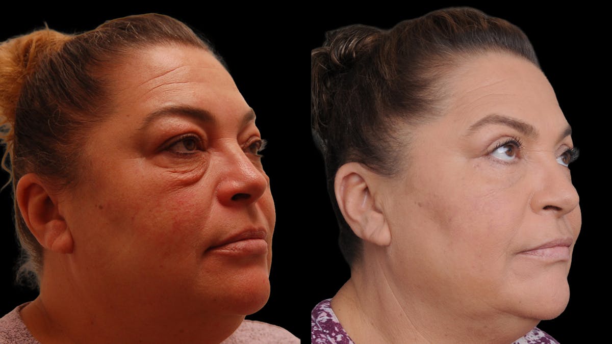 Lower Eyelid Surgery Before & After Gallery - Patient 272736 - Image 4
