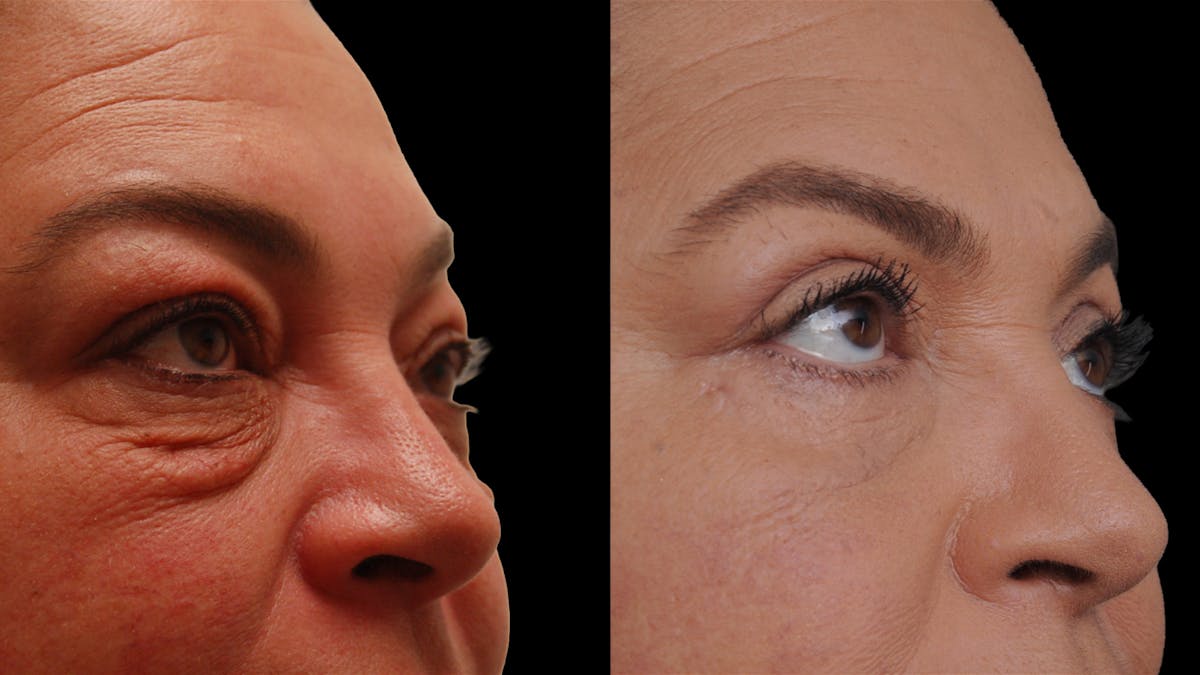 Lower Eyelid Surgery Before & After Gallery - Patient 272736 - Image 9