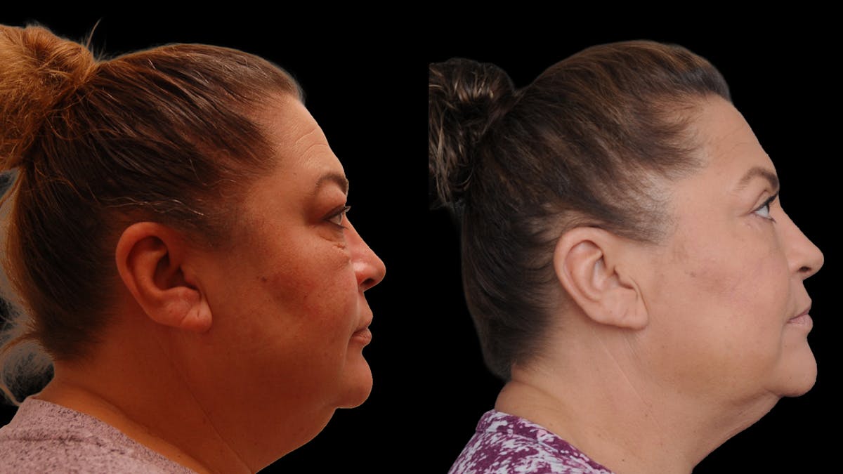 Lower Eyelid Surgery Before & After Gallery - Patient 272736 - Image 5