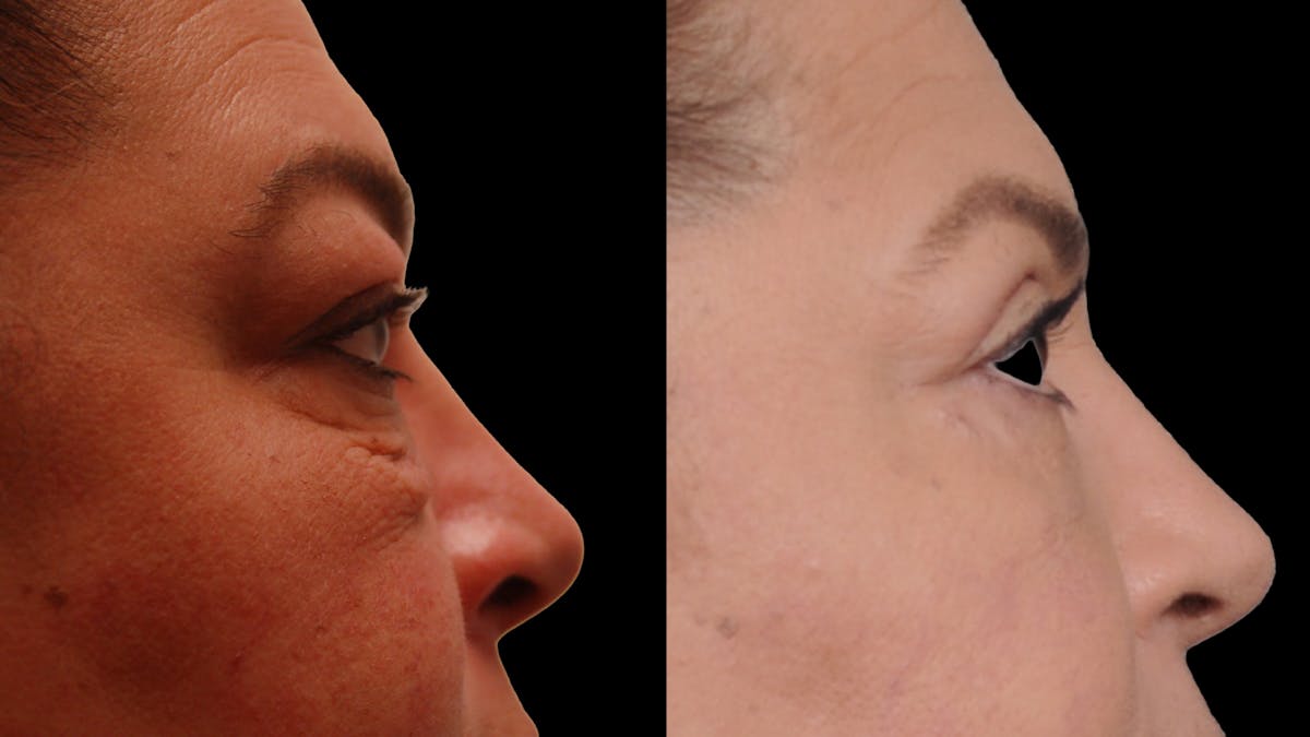 Lower Eyelid Surgery Before & After Gallery - Patient 272736 - Image 10